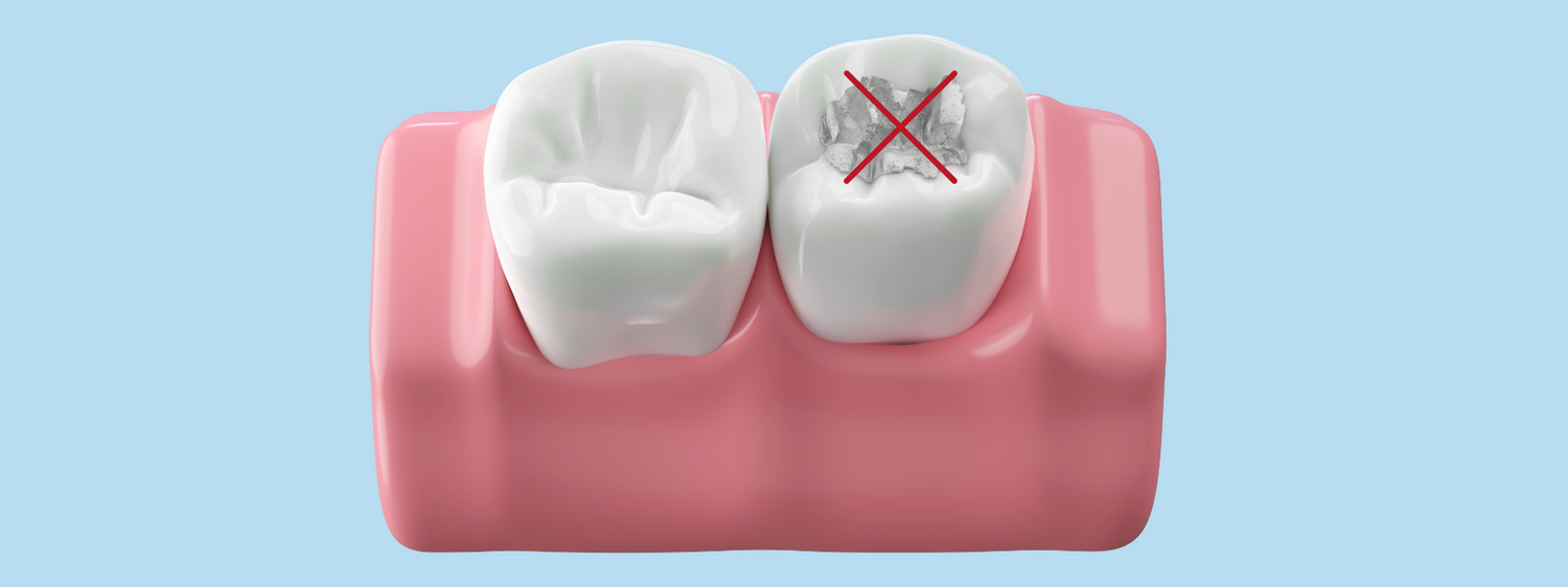 Nach dem Amalgam-Aus: Welche Alternativen gibt es ohne zusätzliche Kosten?