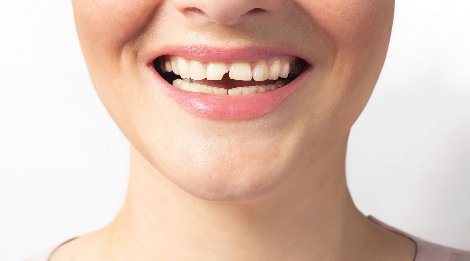 Notfall-Guide: Was tun bei abgebrochenem Zahn, Zahnschmerzen & Co.?