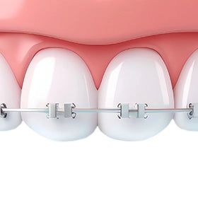 Spangen & Brackets